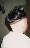 Client before with alopecia aerate at the nape of her neck