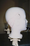 Custom template of area where hair need to be restored